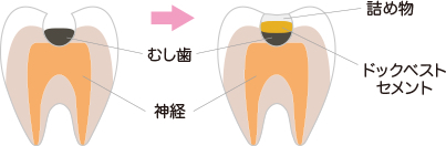 ドックベストセメント治療