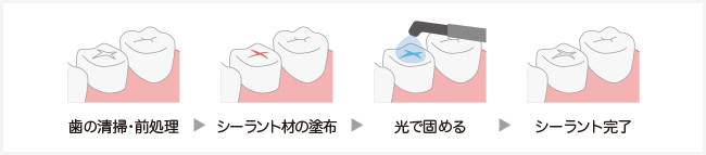 シーラント 虫歯、リン酸エッチング、光照射、シーラント完成