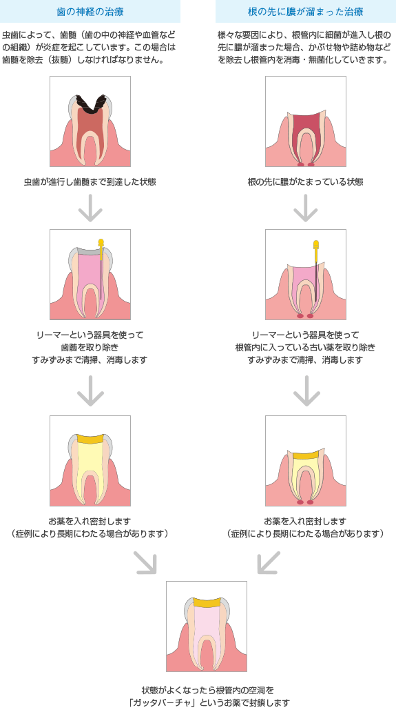 根管治療の流れ