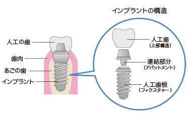 インプラント治療とは