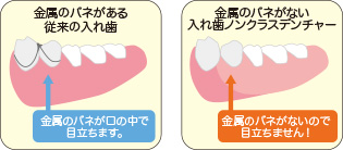 ノンクラスプデンチャー