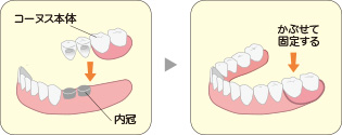 コーヌス義歯