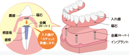 マグネットデンチャー