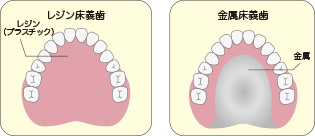 金属床義歯