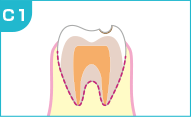 初期の虫歯