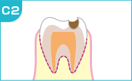 中度の虫歯