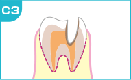重度の虫歯