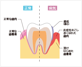 正常な歯と歯周病の歯の状態の比較図